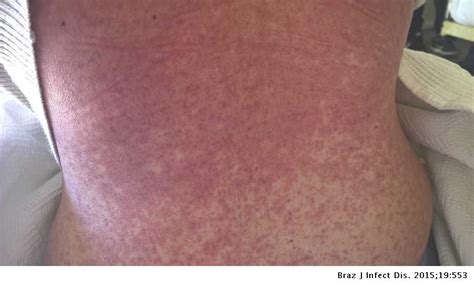 Infectious Mononucleosis Skin Rash Without Previous Antibiotic Use