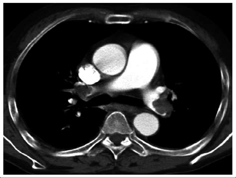 Chest Ct Showing Filling Defect At The Bifurcation Site Of Bilateral