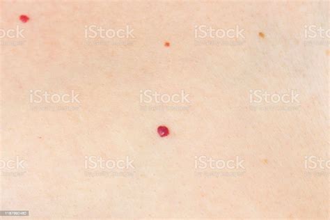Angioma Red Mole On The Skin Bursting Vessel Capillary Many Angiomas In