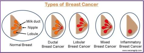 Breast Cancer Types Symptoms Management We Care