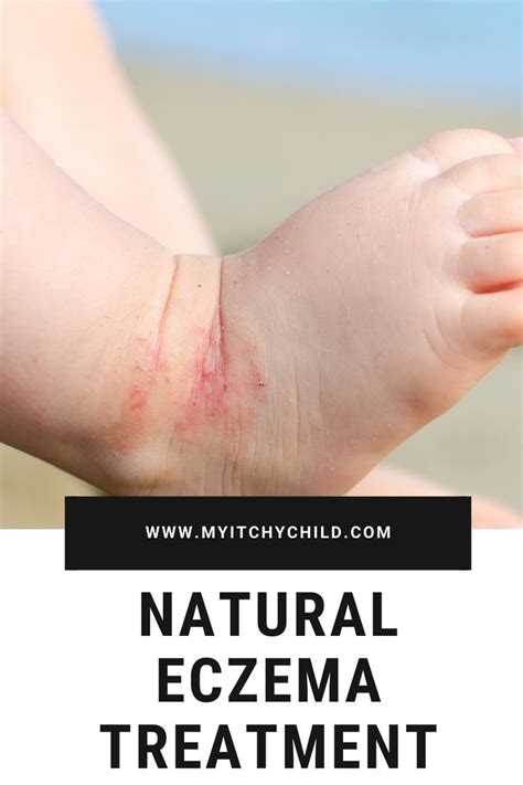 How To Stop Eczema Itching Naturally My Itchy Child In 2020 Eczema