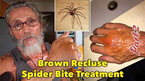 How To Treat A Brown Recluse Spider Bite After Teotwa