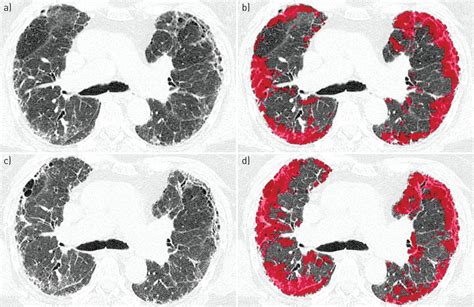 Quantitative High Resolution Computed Tomography Fibrosis Score