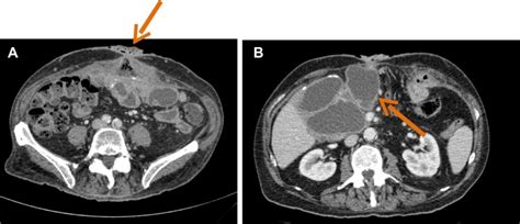 Abdominal Computed Tomography Scan Of A Patient With Evidence Of