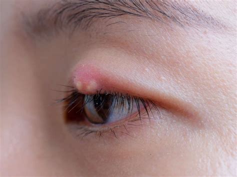 7 Ways To Treat Or Get Rid Of A Stye