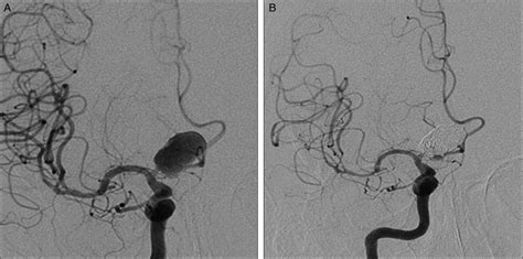 Initial Experience Using The Penumbra Coil Comparison Of Aneurysm Packing Cost