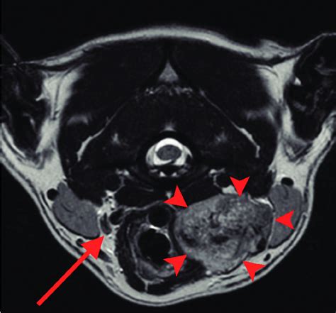 Transverse T2 Weighted Mri Image Of The Head And Neck Of A Pit