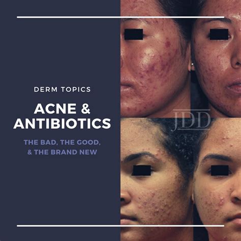 Antibiotics And Acne The Bad The Good And The Brand New Next Steps