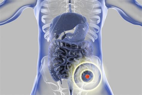 Treatment For Liver Metastasis From Colorectal Cancer