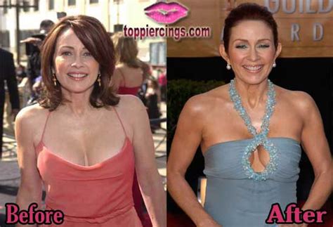 Patricia Heaton Plastic Surgery Before And After Top