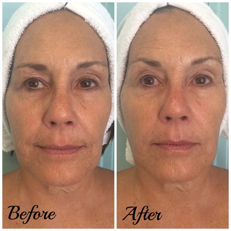 We did not find results for: Client Before/After Treatment • Sleekskin® Aesthetics of ...