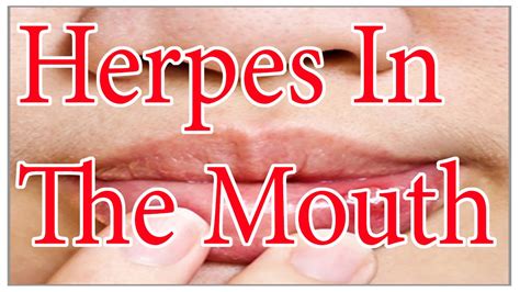 Herpes In The Mouth Oral Herpes Symptoms And Treatment YouTube