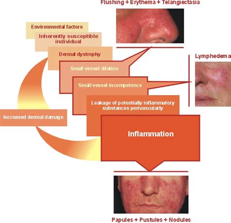 What Causes Rosacea