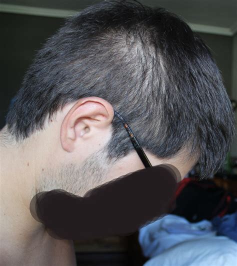For one more thinning hair treatment you can try at home, consider daily scalp massage and exercises. Long term DIFFUSE hair loss after Accutane and sebum ...