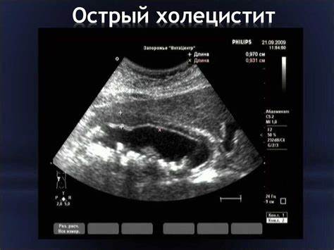 Лапароскопия желчного пузыря (удаление камней либо всего органа путём Картинка - Лапароскопия желчного пузыря (удаление камней либо всего органа путём