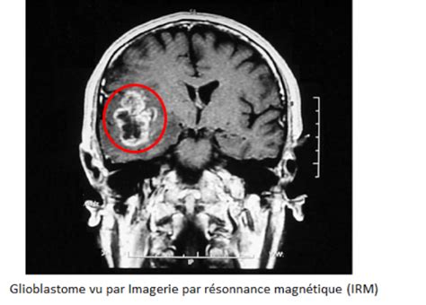 Diagnostic Irm Tumeur Cérébrale Institut Du Cerveau