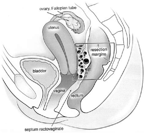 Figure From Histopathological Extent Of Rectal Invasion By
