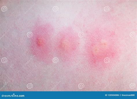 Mosquito Bite To The Foot Inflammation Stock Photo Image Of Bite