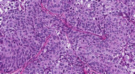 Carcinoma espinocelular do colo do útero MyPathologyReport ca