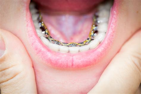 Lingual Dental Braces Miami Fl Orthodontist