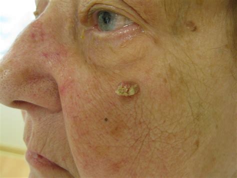 10 Common Skin Diseases With Photos Health Service Navigator