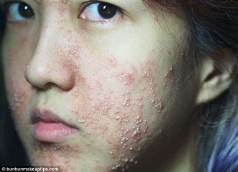 My Post Facial Hell Beauty Blogger Suffers Horrific Allergic Reaction To Spa Treatment