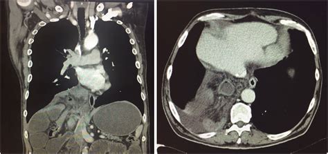 Hernia Diafragmática Derecha Complicada Tras Hepatectomía Presentación