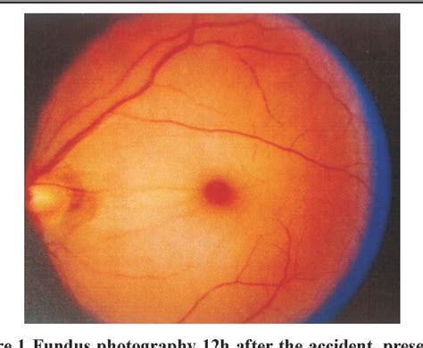 Central Retinal Artery Occlusion Cherry Red Spot