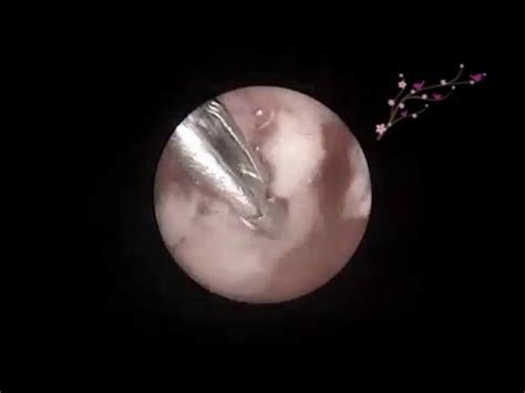 Uterine polyp removal is a surgical procedure done to take out polyps that have developed on the often, the first step in uterine polyp removal is a procedure known as dilation and curettage. Endometrial polyp removal - YouTube