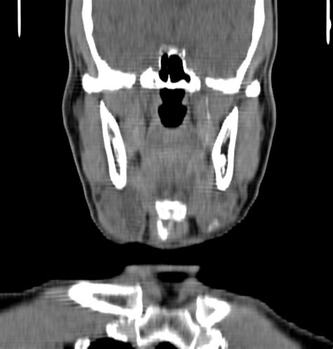 Bilateral Submandibular Sialolithiasis With Sialadenitis Image
