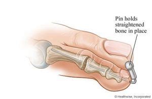 La Chirurgie De Lorteil Marteau Et En Griffe Podiamed