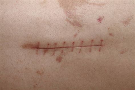 Stitches And Scars Stock Photos Pictures And Royalty Free Images Istock
