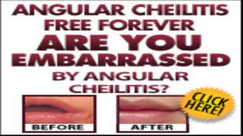 Treatment For Angular Cheilitis For Corners Of Mouth Sore Youtube