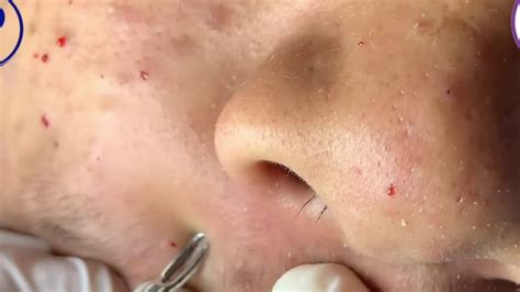 Top Blackheads Removal Youtube