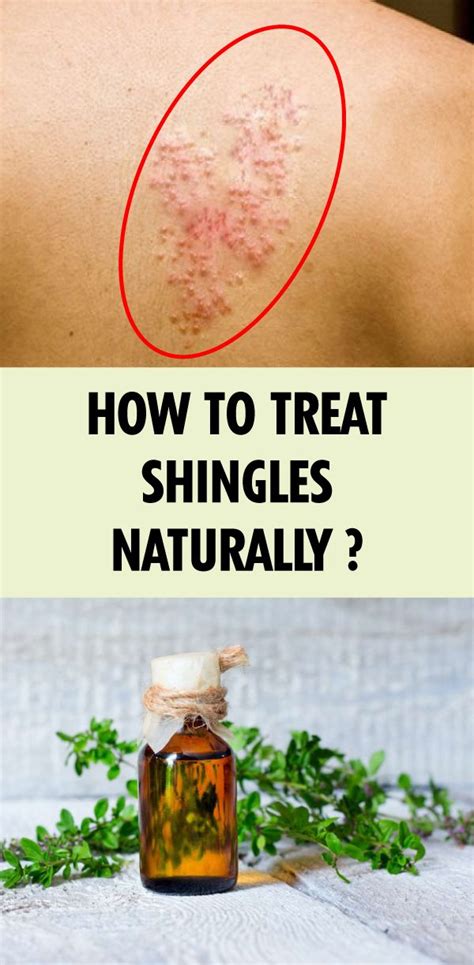 How To Treat Shingles Naturally Shingling Treating Shingles Home