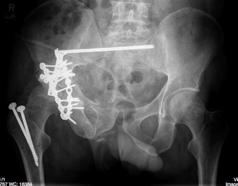 Pelvic Fracture Ideas Fracture Pelvis Hip Injuries My XXX Hot Girl