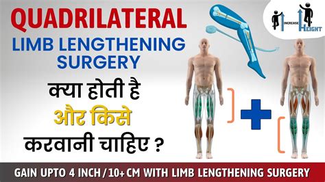 Quadrilateral Limb Lengthening क्या है और किसे करवानी चाहिए What Is