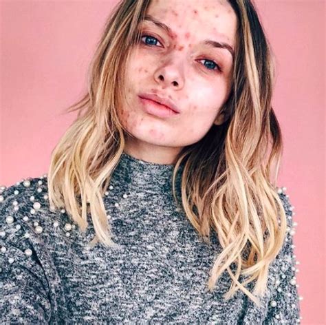 Acne Positivity Is The Instagram Movement Youve Been Waiting For
