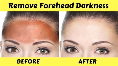 Get Rid Of Dark Forehead In Just 20 Minutes Permanently Whiten
