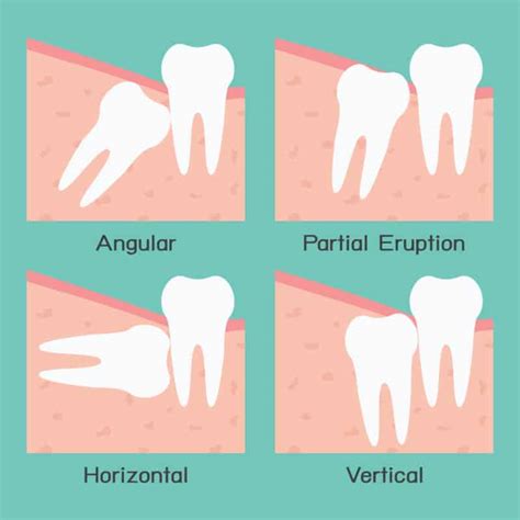 impacted wisdom teeth removal when should you get your wisdom teeth removed