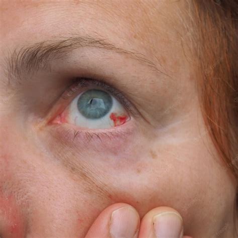 Premium Photo Subconjunctival Hemorrhage Or Subconjunctival Bleeding