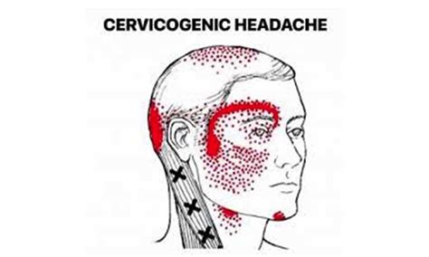 Cervicogenic Headaches Arash Noor Dc Ccsp Cscs Emt R Chiropractor