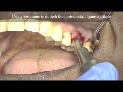 Few Extraction Tips Basic For Upper First Molar Removal Youtube