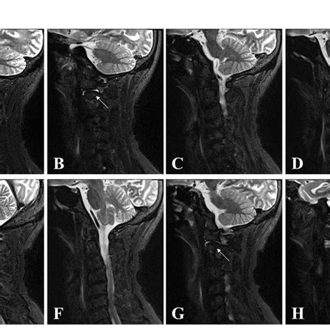 Cervical Computed Tomography Ct Scans Around The Odontoid Process