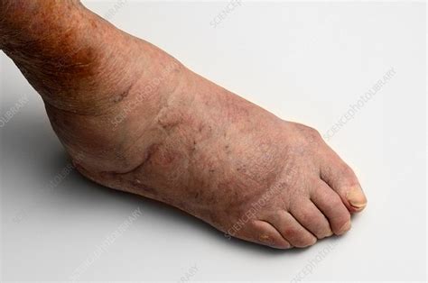Rheumatoid Arthritis Of The Foot Stock Image C0139736 Science Photo Library