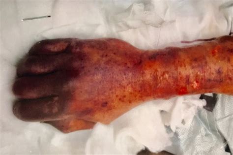 Sepsis happens when an infection triggers a potentially life threatening immune response throughout the body. Man Dies After Being Licked by His Dog in Tragic And Rare ...