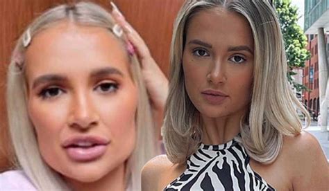 Molly Mae Hague Rallies Against Face Fillers After Having Hers Dissolved Extraie