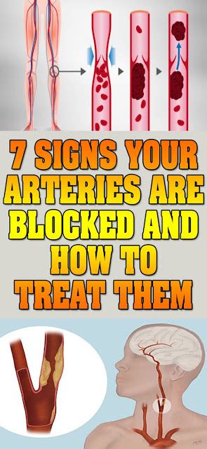 7 Signs Your Arteries Are Blocked And How To Treat Them Fitness Fiesta