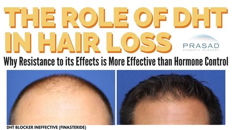 Dht And Hair Loss In Men Why Reversing The Effects Of Dht Can Work