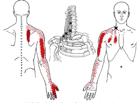 Figure From Diagnosis Of Myofascial Pain Syndrome Semantic Scholar